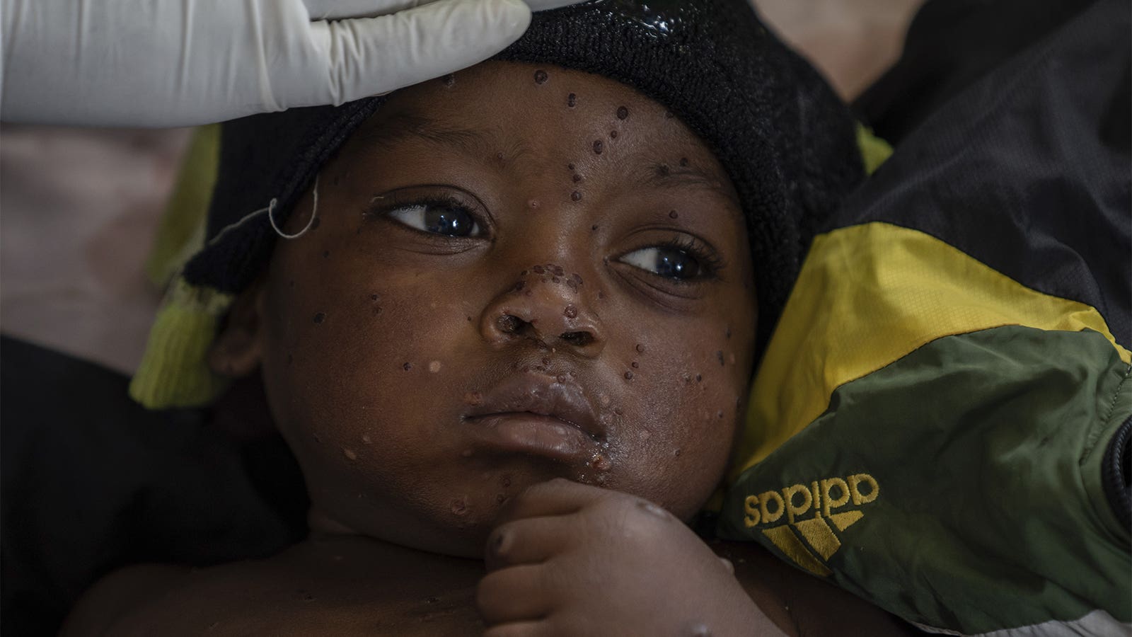 Mpox Cases in Congo May Be Stabilizing